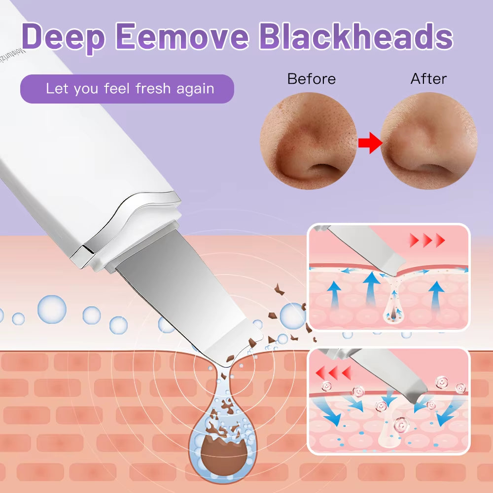 Ultrasonic Facial Skin Scrubber — Deep Pore & Blackhead Cleansing Spatula
